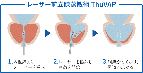 レーザー前立腺蒸散術　ThuVAPの流れ